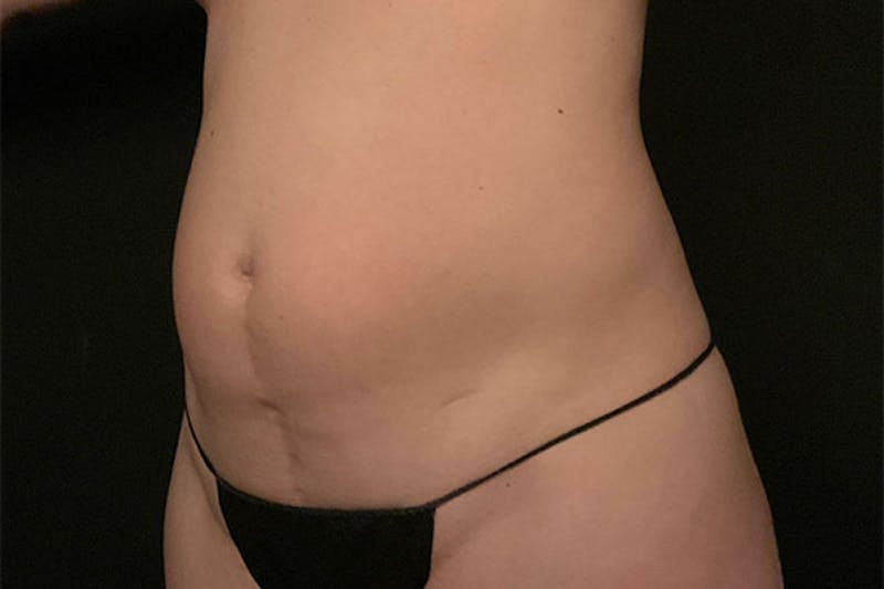 Abdominoplasty Before & After Gallery - Patient 282513 - Image 1