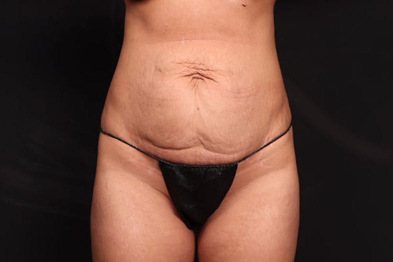 Abdominoplasty Before & After Gallery - Patient 249324 - Image 1