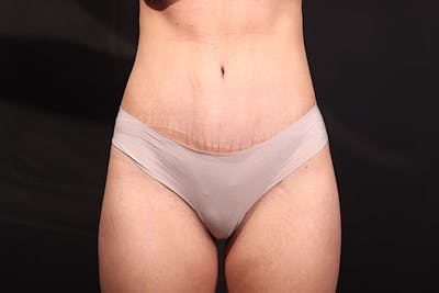 Abdominoplasty Before & After Gallery - Patient 249324 - Image 2