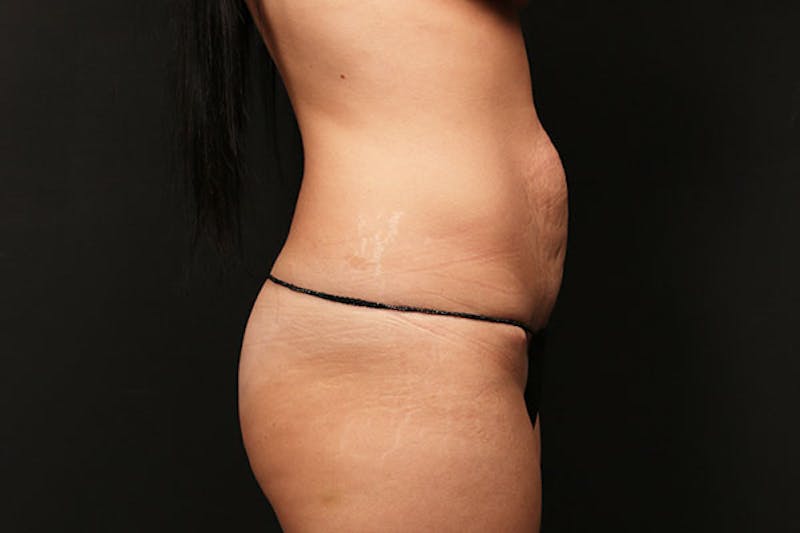 Abdominoplasty Before & After Gallery - Patient 953583 - Image 1
