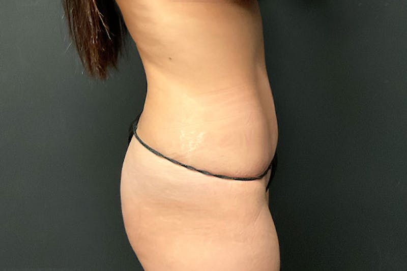 Abdominoplasty Before & After Gallery - Patient 953583 - Image 2