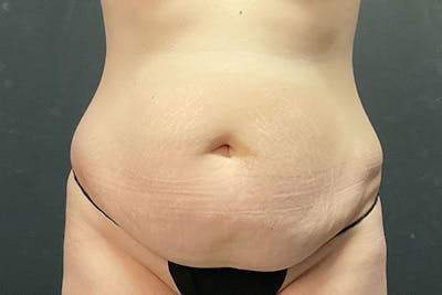 Abdominoplasty Before & After Gallery - Patient 675208 - Image 1
