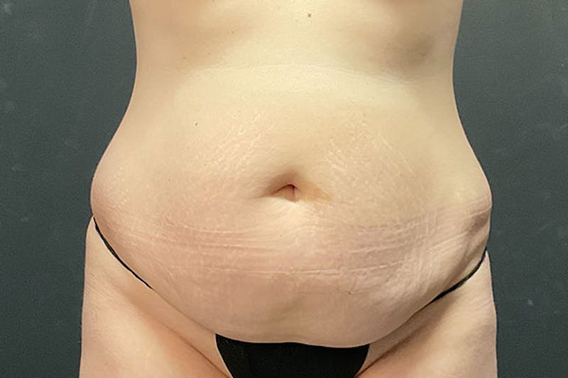 Abdominoplasty Before & After Gallery - Patient 675208 - Image 1