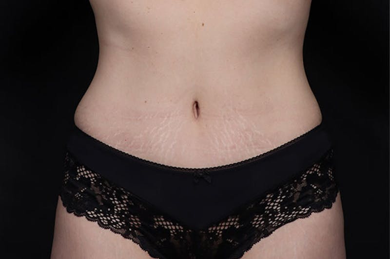 Abdominoplasty Before & After Gallery - Patient 675208 - Image 2
