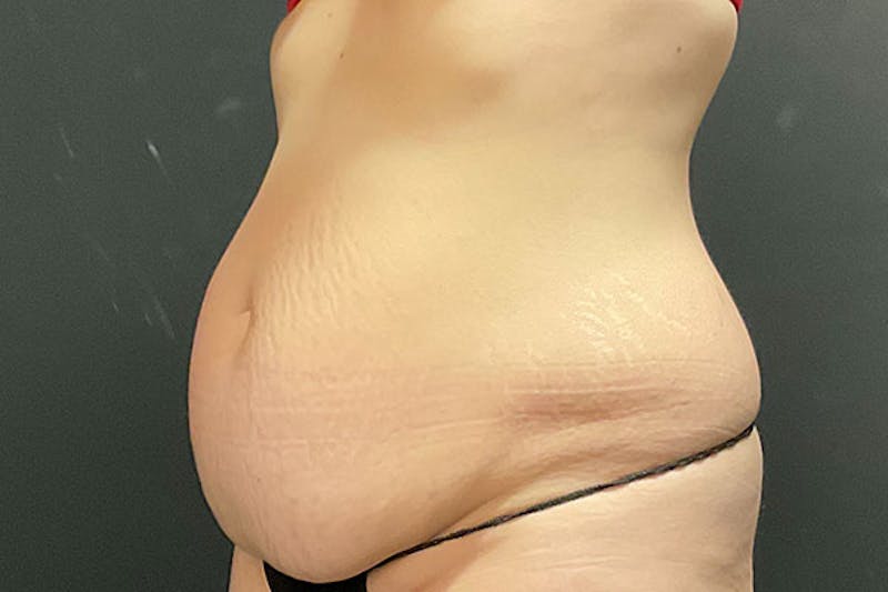 Abdominoplasty Before & After Gallery - Patient 675208 - Image 3