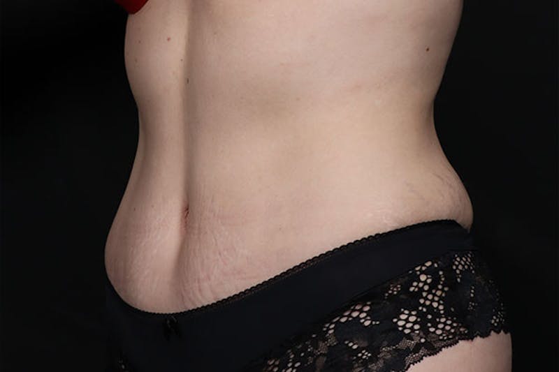 Abdominoplasty Before & After Gallery - Patient 675208 - Image 4