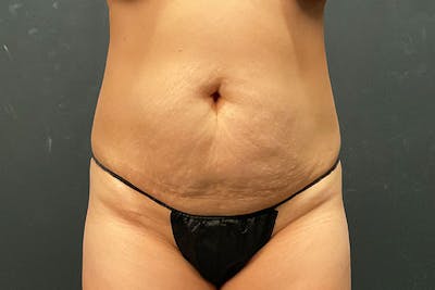 Abdominoplasty Before & After Gallery - Patient 269809 - Image 1