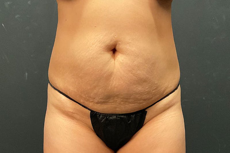 Abdominoplasty Before & After Gallery - Patient 269809 - Image 1