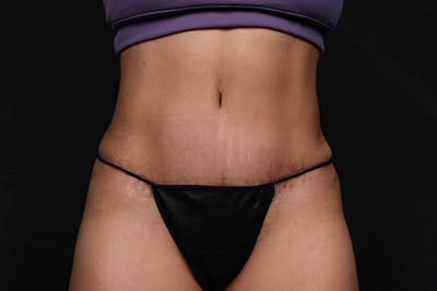 Abdominoplasty Before & After Gallery - Patient 269809 - Image 2