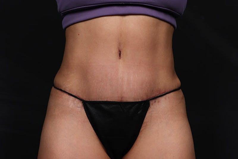 Abdominoplasty Before & After Gallery - Patient 269809 - Image 2