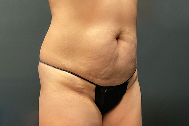 Abdominoplasty Before & After Gallery - Patient 269809 - Image 3