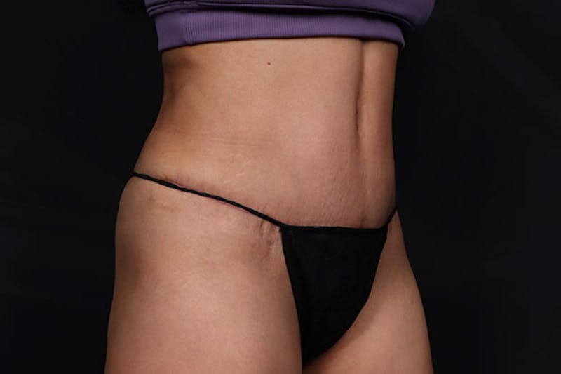 Abdominoplasty Before & After Gallery - Patient 269809 - Image 4