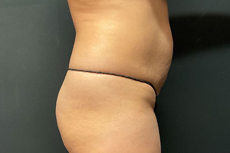 Abdominoplasty Before & After Gallery - Patient 269809 - Image 5