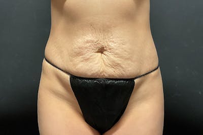 Abdominoplasty Before & After Gallery - Patient 129458 - Image 1