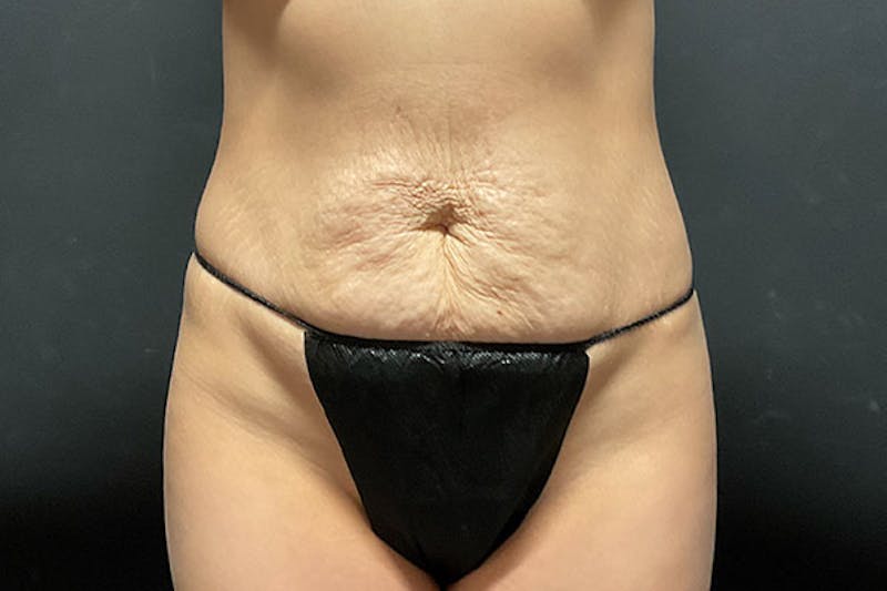 Abdominoplasty Before & After Gallery - Patient 129458 - Image 1