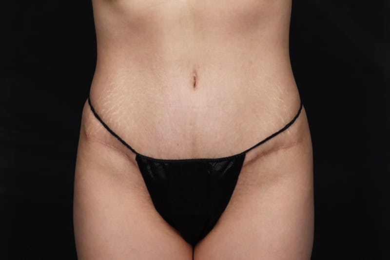 Abdominoplasty Before & After Gallery - Patient 129458 - Image 2