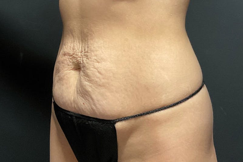 Abdominoplasty Before & After Gallery - Patient 129458 - Image 3