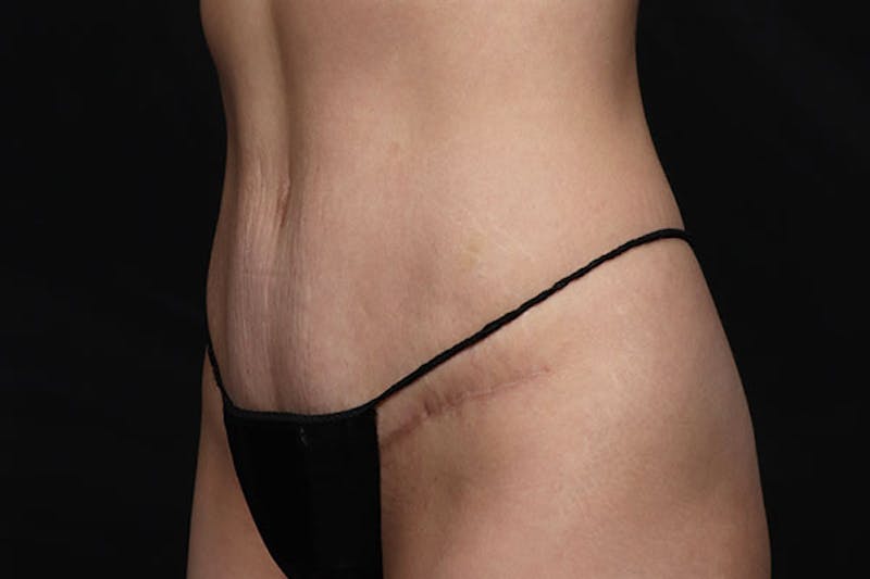 Abdominoplasty Before & After Gallery - Patient 129458 - Image 4