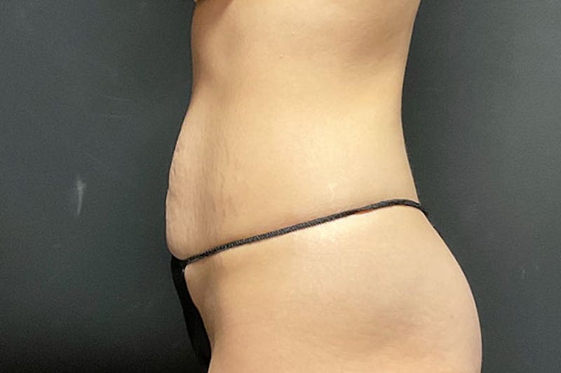 Abdominoplasty Before & After Gallery - Patient 129458 - Image 5