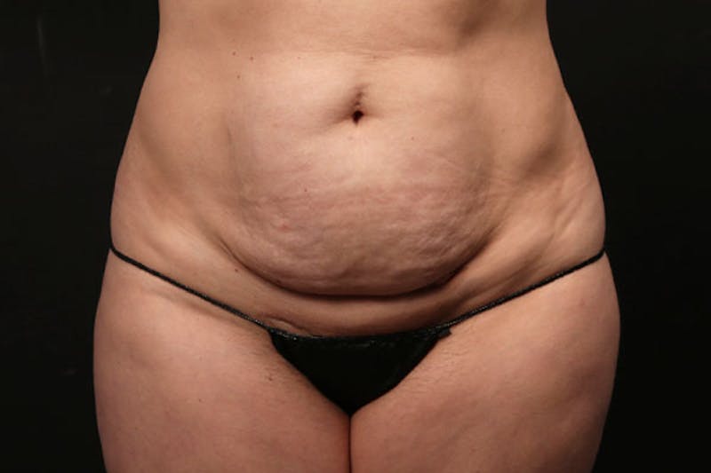 Abdominoplasty Before & After Gallery - Patient 131608 - Image 1