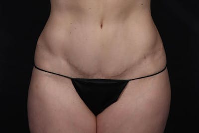 Abdominoplasty Before & After Gallery - Patient 131608 - Image 2