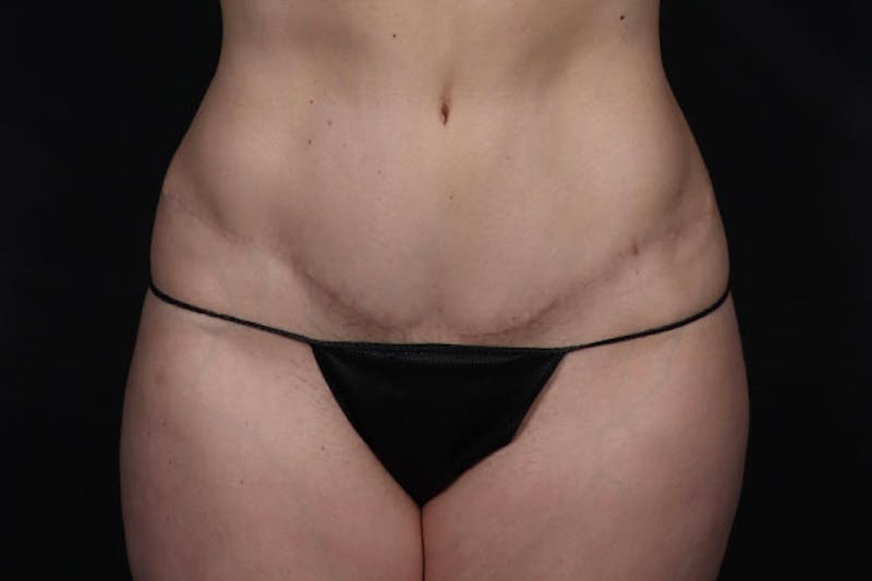Abdominoplasty Before & After Gallery - Patient 131608 - Image 2