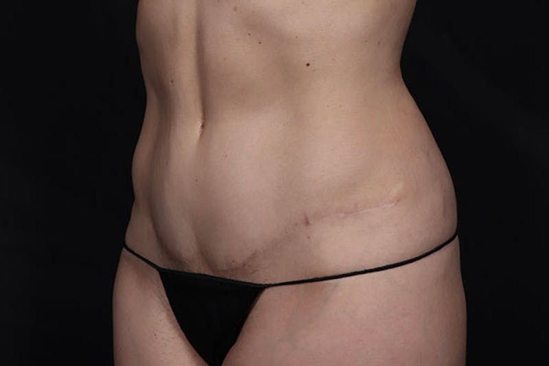 Abdominoplasty Before & After Gallery - Patient 131608 - Image 4