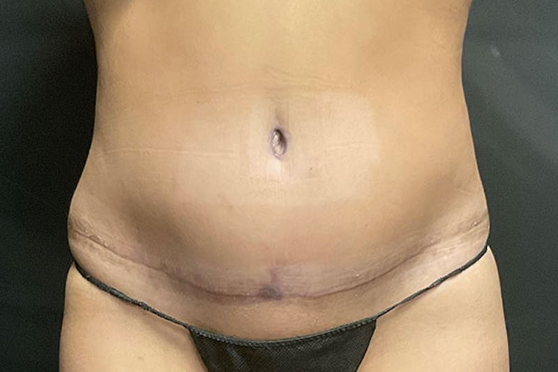 Abdominoplasty Before & After Gallery - Patient 317316 - Image 1