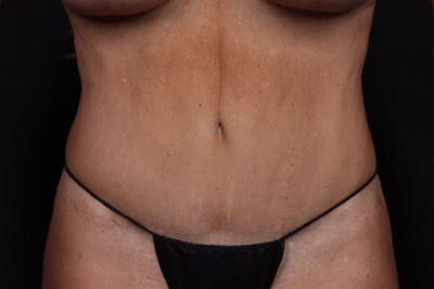 Abdominoplasty Before & After Gallery - Patient 317316 - Image 2
