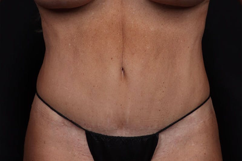 Abdominoplasty Before & After Gallery - Patient 317316 - Image 2
