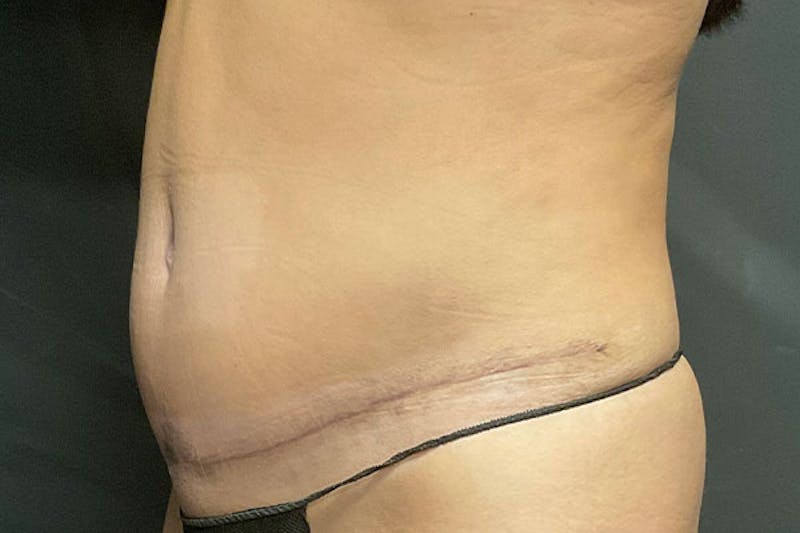 Abdominoplasty Before & After Gallery - Patient 317316 - Image 3