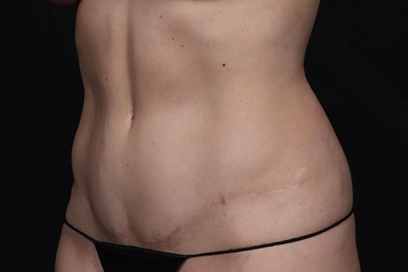 Abdominoplasty Before & After Gallery - Patient 317316 - Image 4