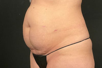 Abdominoplasty Before & After Gallery - Patient 230292 - Image 1