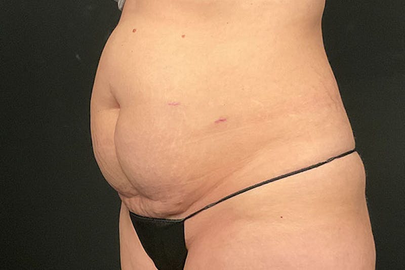 Abdominoplasty Before & After Gallery - Patient 230292 - Image 1