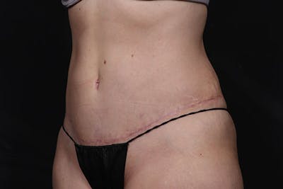 Abdominoplasty Before & After Gallery - Patient 230292 - Image 2