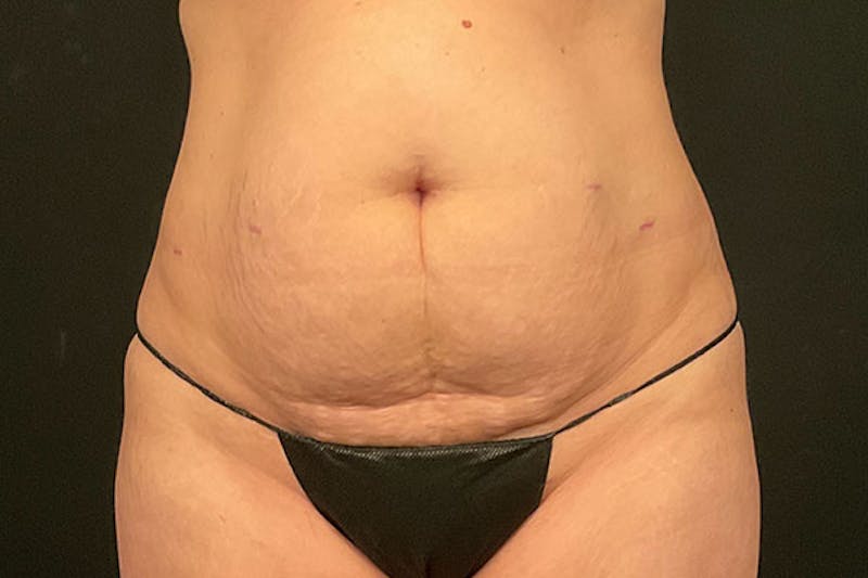 Abdominoplasty Before & After Gallery - Patient 230292 - Image 5