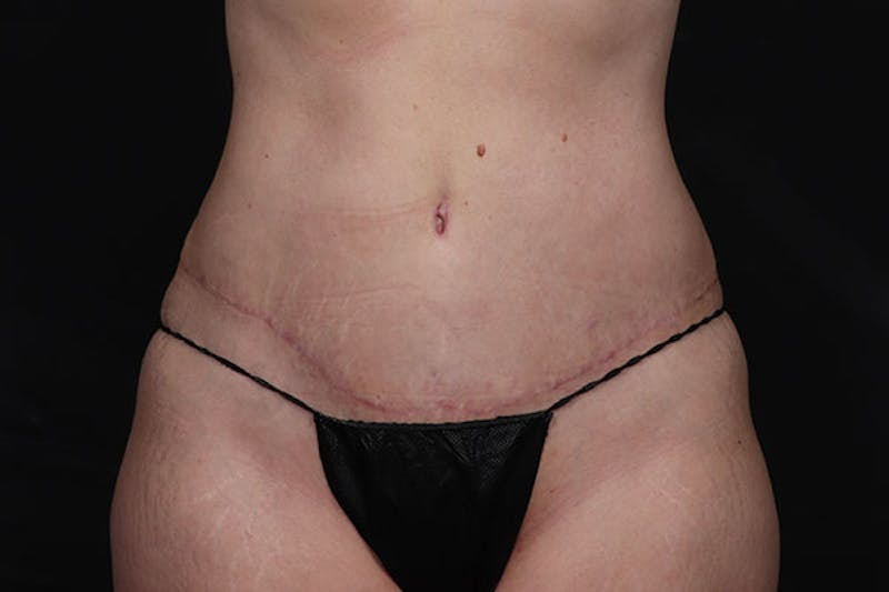 Abdominoplasty Before & After Gallery - Patient 230292 - Image 6