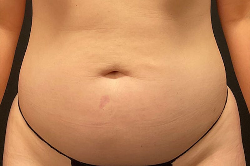 Abdominoplasty Before & After Gallery - Patient 126883 - Image 1