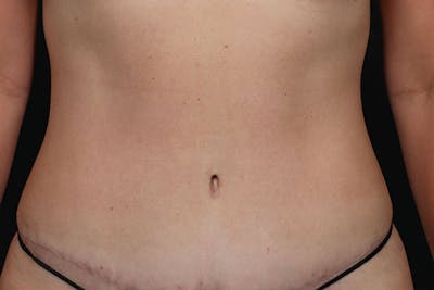 Abdominoplasty Before & After Gallery - Patient 126883 - Image 2