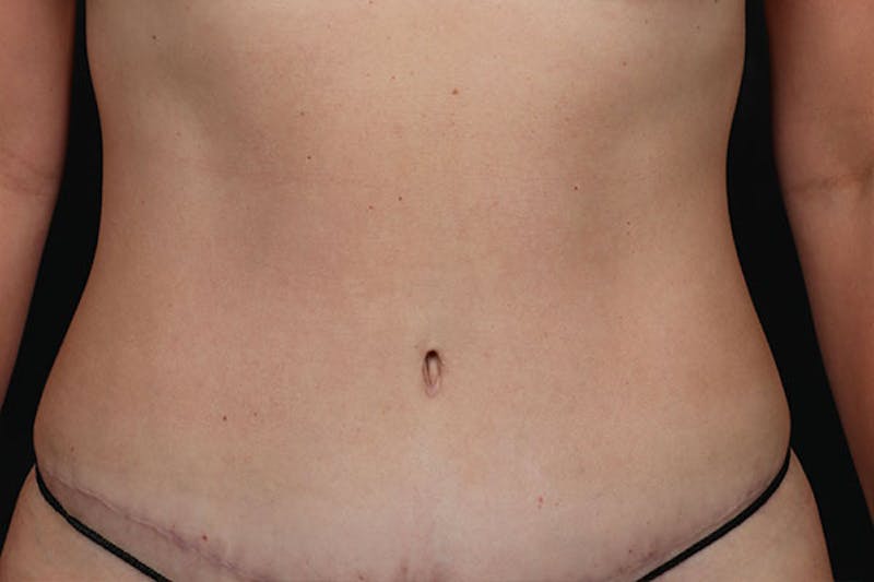Abdominoplasty Before & After Gallery - Patient 126883 - Image 2