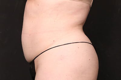 Abdominoplasty Before & After Gallery - Patient 688167 - Image 1