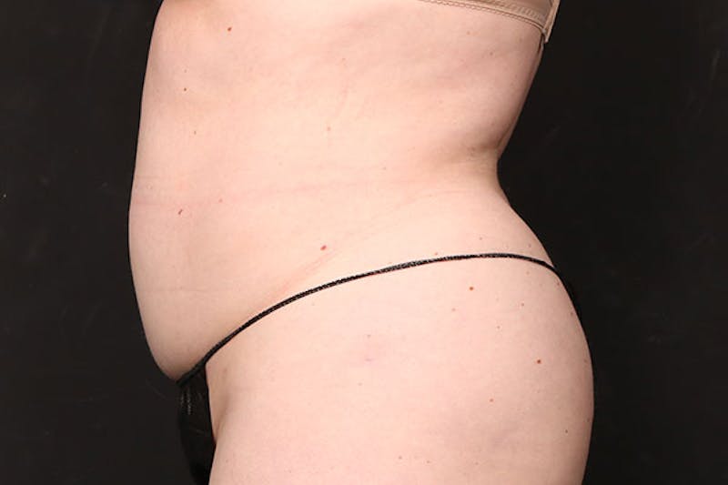 Abdominoplasty Before & After Gallery - Patient 688167 - Image 1