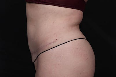 Abdominoplasty Before & After Gallery - Patient 688167 - Image 2