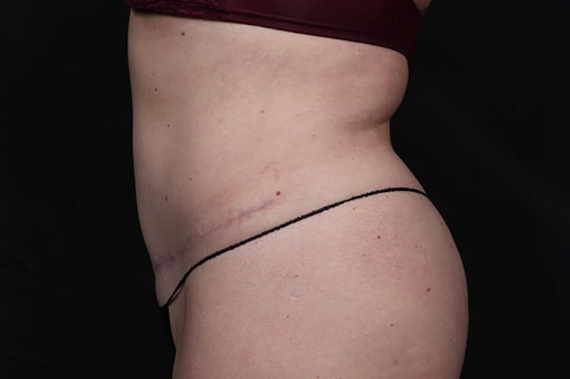 Abdominoplasty Before & After Gallery - Patient 688167 - Image 2