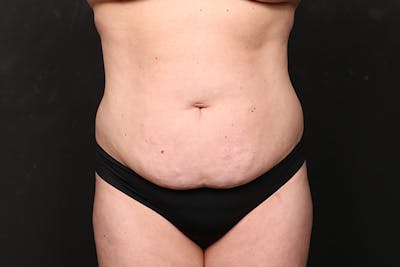 Abdominoplasty Before & After Gallery - Patient 377055 - Image 1