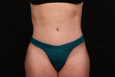 Abdominoplasty Before & After Gallery - Patient 377055 - Image 2