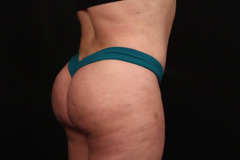 Abdominoplasty Before & After Gallery - Patient 377055 - Image 4