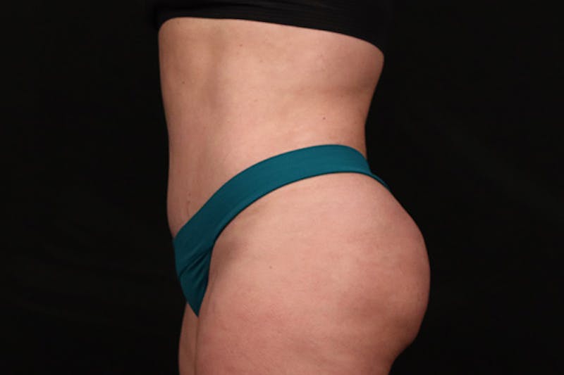 Abdominoplasty Before & After Gallery - Patient 377055 - Image 6