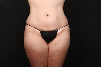 Abdominoplasty Before & After Gallery - Patient 259408 - Image 1