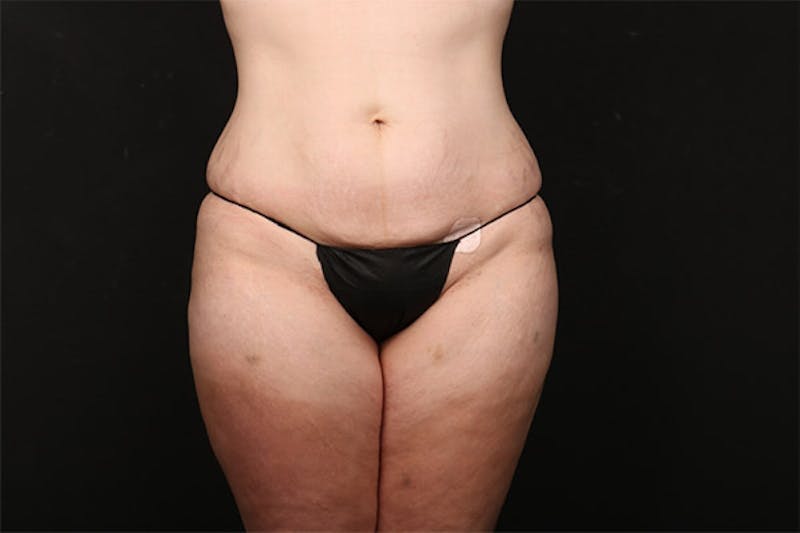 Abdominoplasty Before & After Gallery - Patient 259408 - Image 1